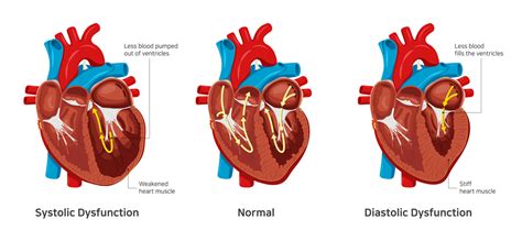 mild lv diastolic dysfunction means|mild diastolic dysfunction treatment.